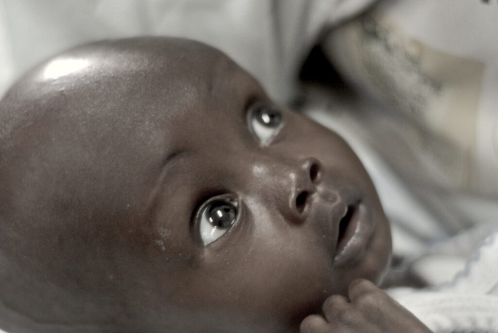 child with hydrocephalus