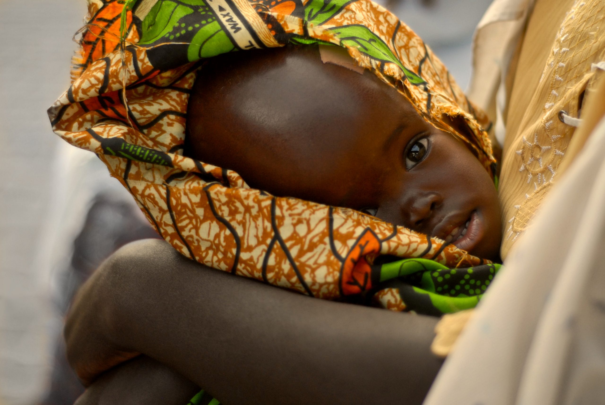 infant with hydrocephalus